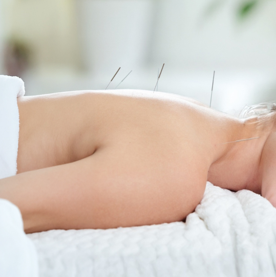 Eine Frau liegt entspannt auf einer Liege während einer Akupunktur-Behandlung.